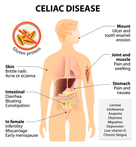 celiac disease