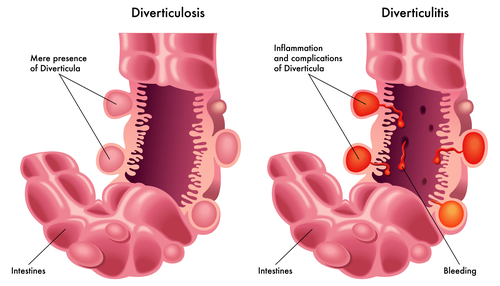 Diverticulitis