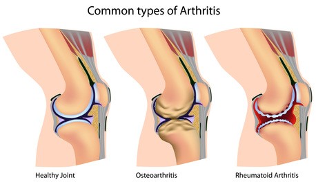 joint inflammation