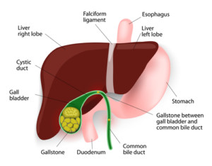 gallstones