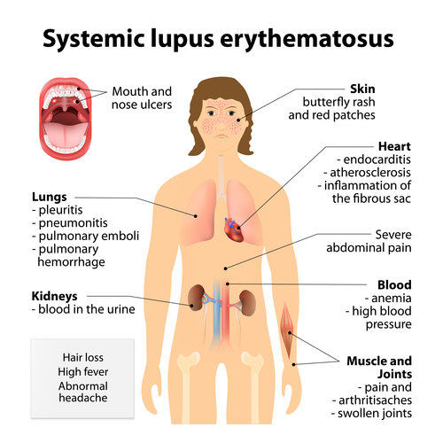 lupus and neuropathy