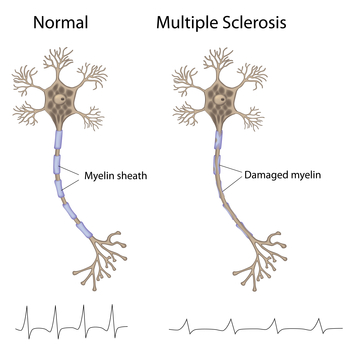 multiple sclerosis