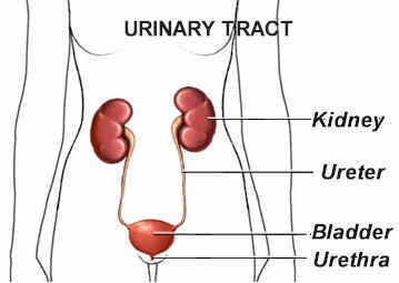 kidney stones