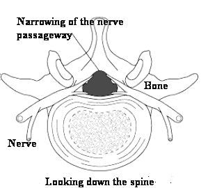 spinal stenosis