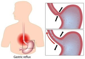 reflux