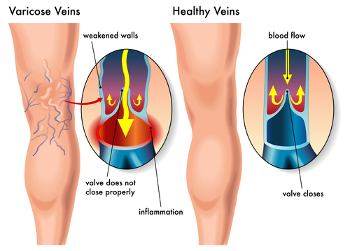 Varicose veins