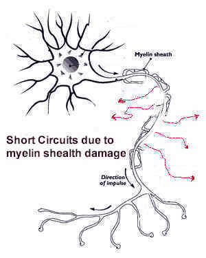 nerve cell with damaged myelin sheath