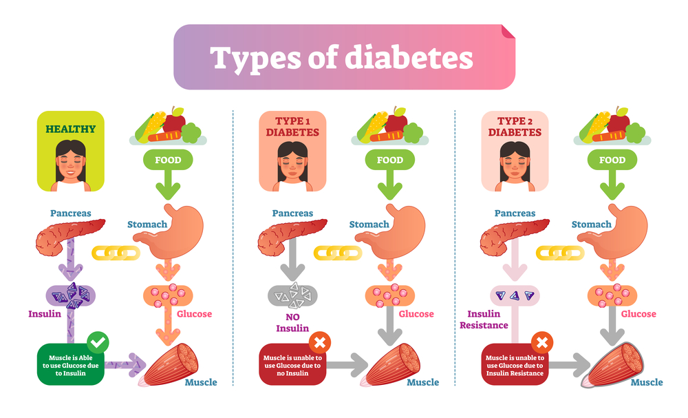 types of diabetes