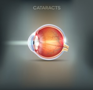 cataract and vision