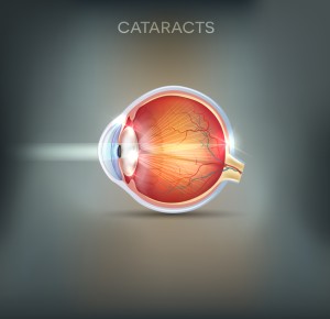 cataracts