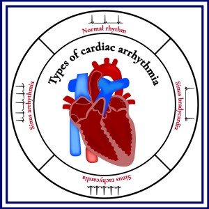 types of cardia arrhthmia