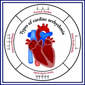 cardiac arrhythmias