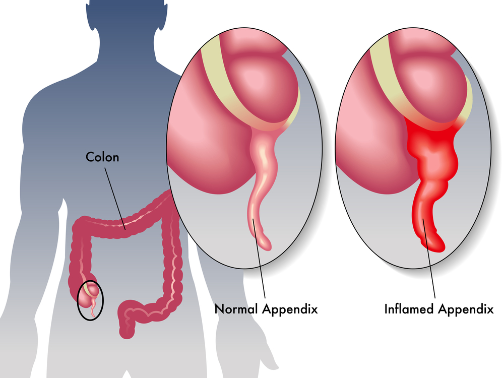 Appendicitis – Appendix Infection - MCVitamins